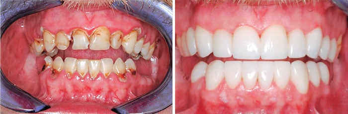 Strober Restorative Dentistry Before and After