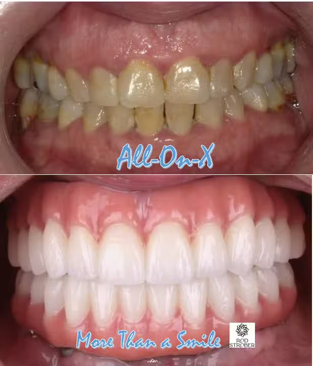 Before-and-after full-arch implant treatment from Country Club Dentistry