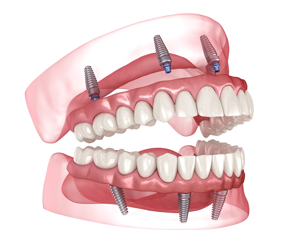 All-on-X dental implant restoration at Country Club Dentistry