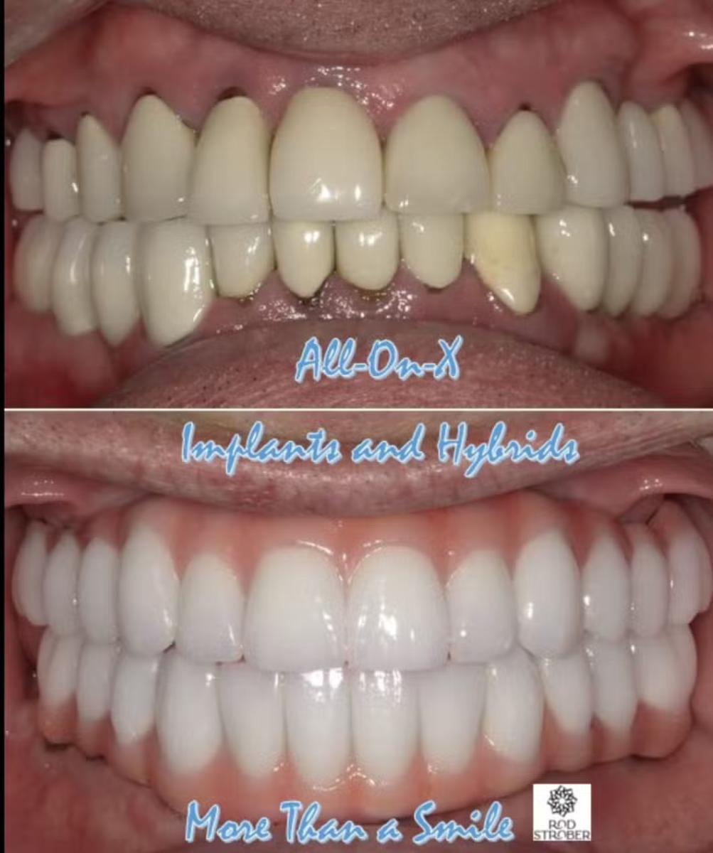 Upper and lower All-on-X implant restoration