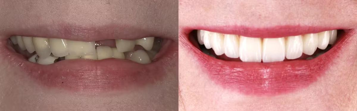 All-on-X dental implant case view 05