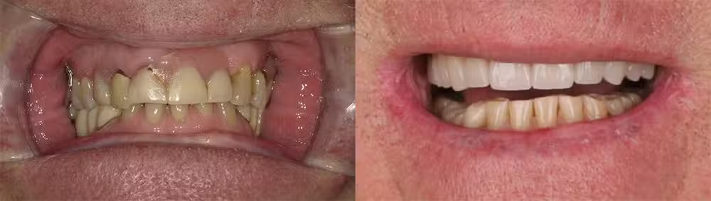 All-on-X dental implant case view 02