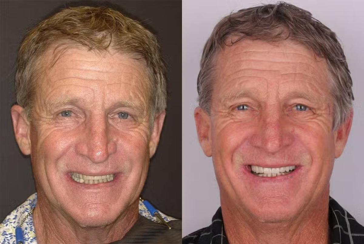All-on-X dental implant case view 01