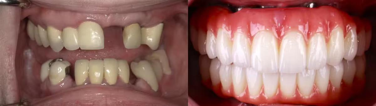 All-on-X dental implant case view 06