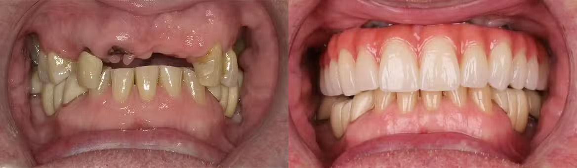 All-on-X dental implant case view 03