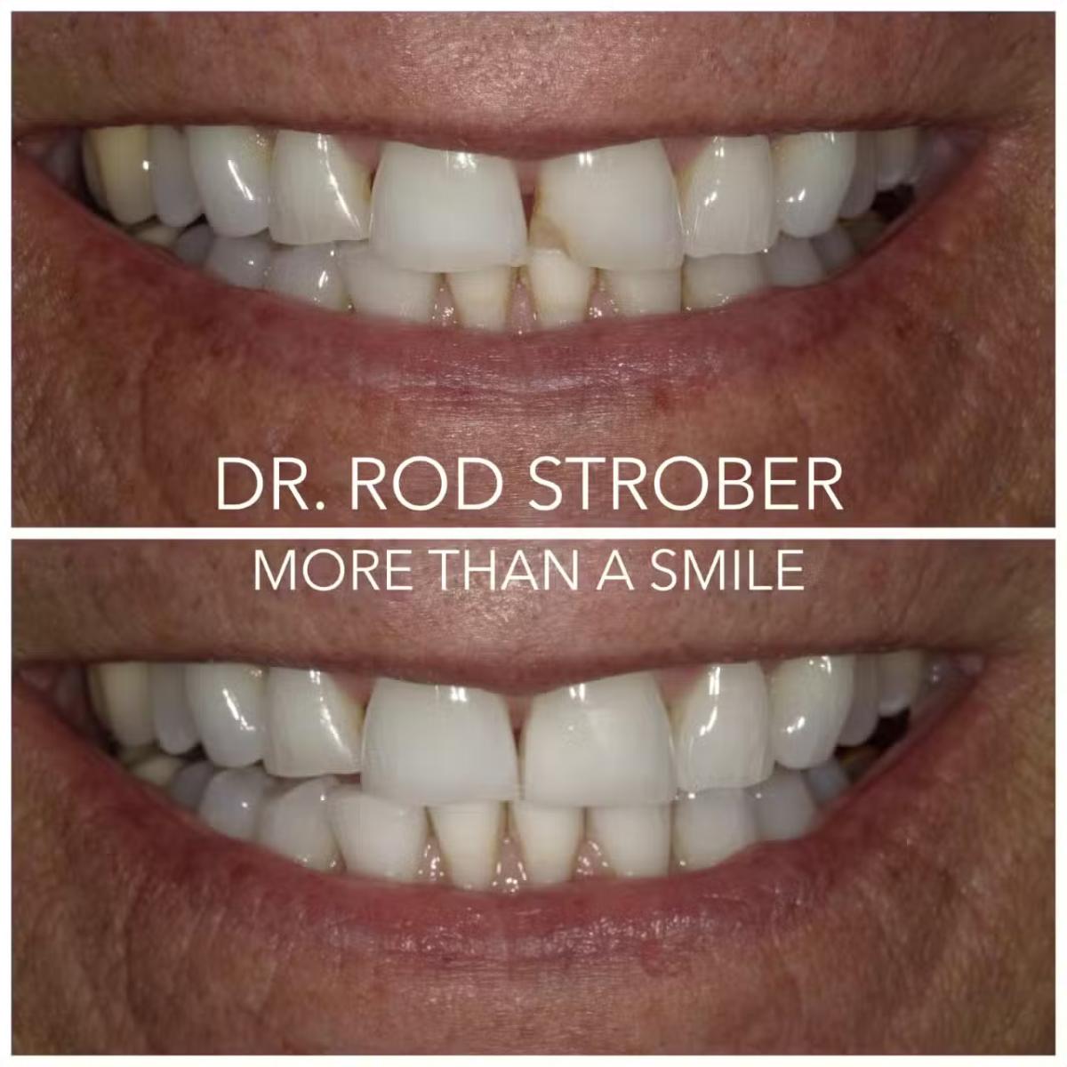 BioClear composite dentistry case