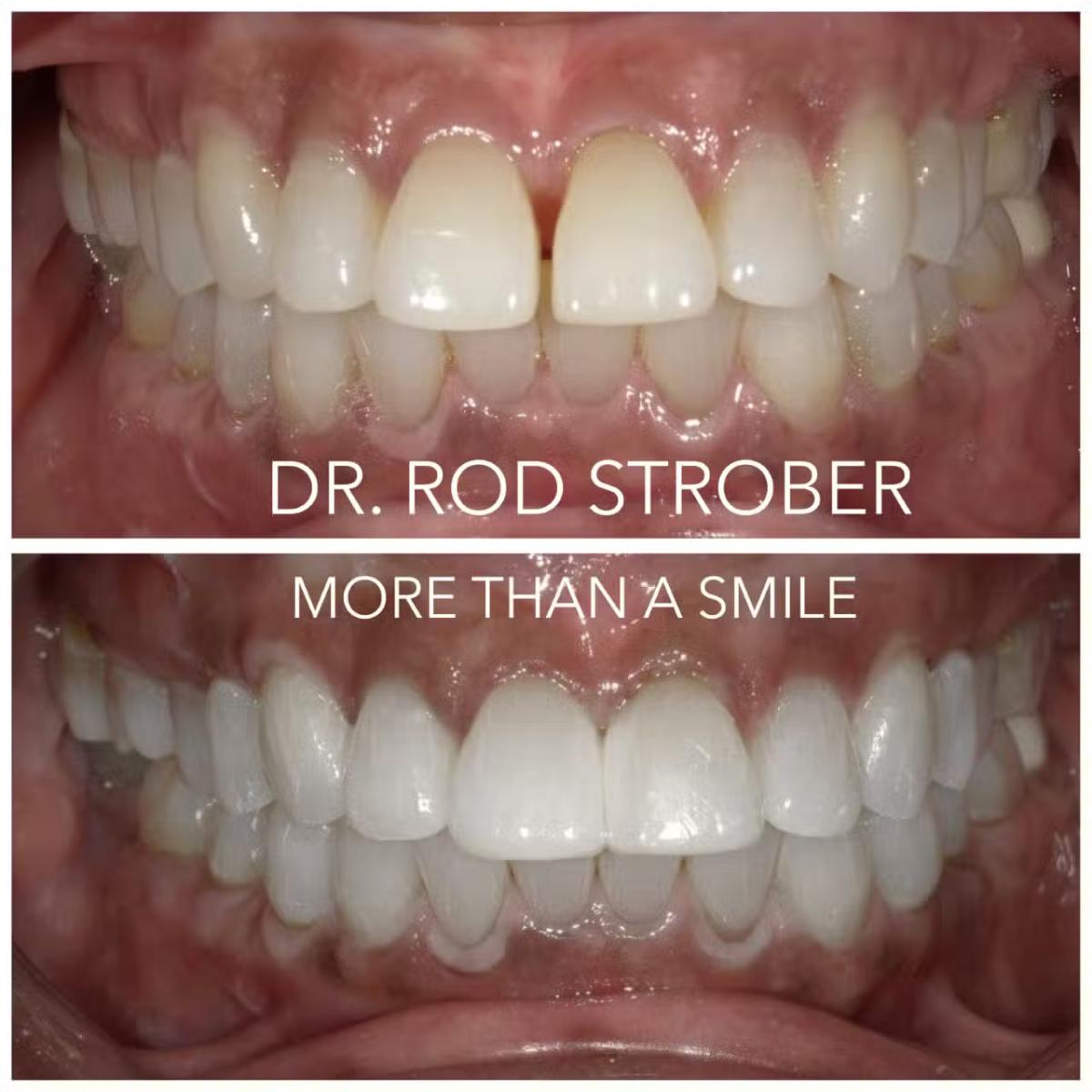 BioClear cosmetic tooth reshaping case