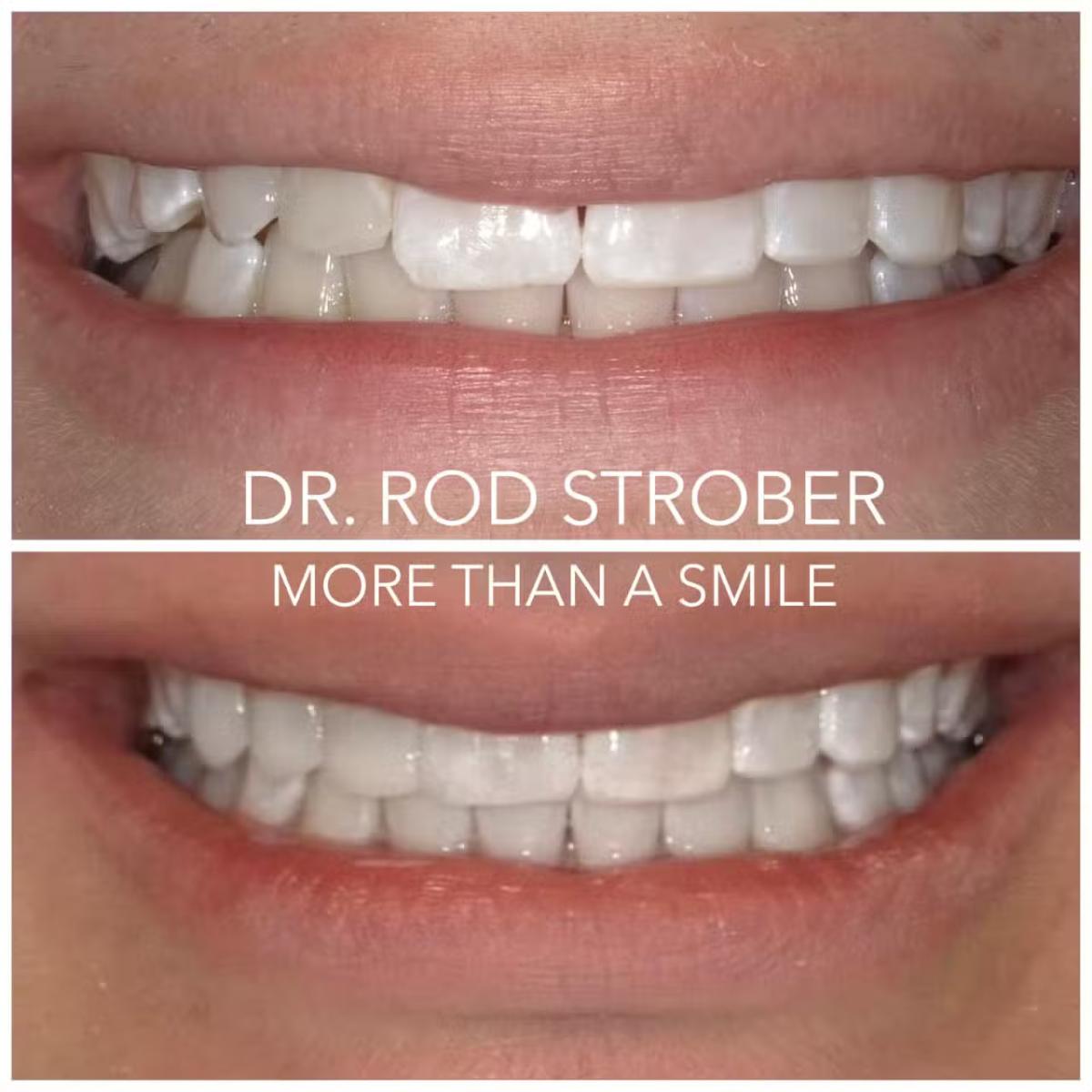 BioClear smile enhancement case