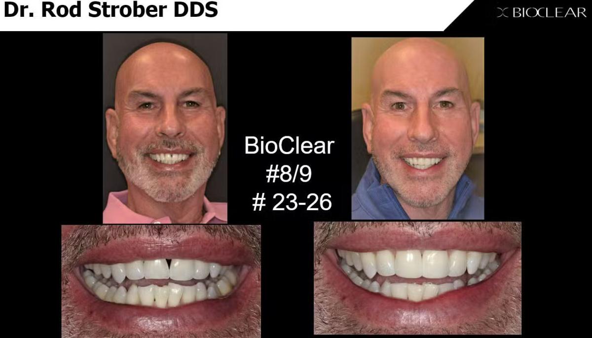 BioClear before and after dental case