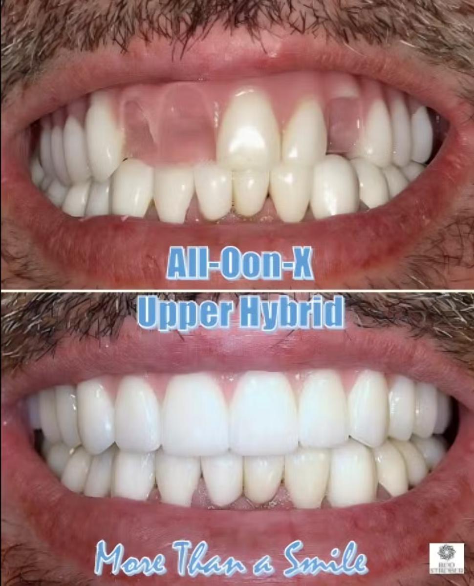All-on-X upper full-arch restoration