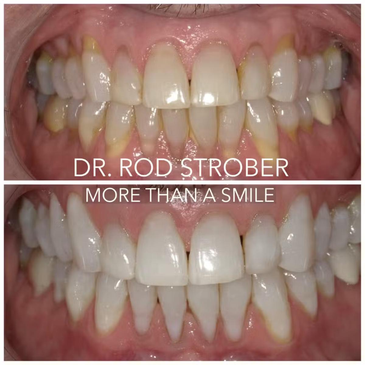 BioClear cosmetic dentistry case