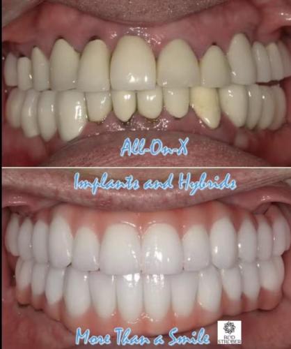 All-on-X-Upper-and-Lower-implants-and-All-on-X-hYbrids-edited.png