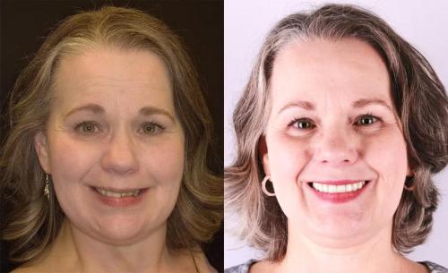 BEFORE-AFTER-all-on-x-smile-face-1.1.jpg