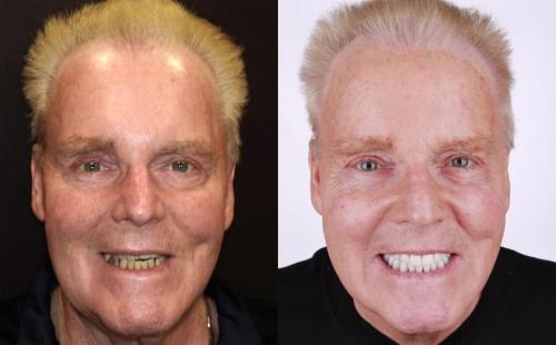 BEFORE-AFTER-crowns-smile-face-1-scaled.jpg_converted