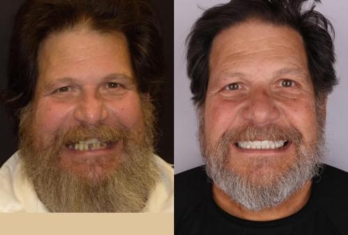 BEFORE-AFTER-full-reconstruction-implants-crowns-smile-face-1-scaled.jpg_converted
