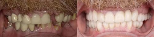 BEFORE-AFTER-full-reconstruction-implants-crowns-smile-full-mouth-2.jpg_converted