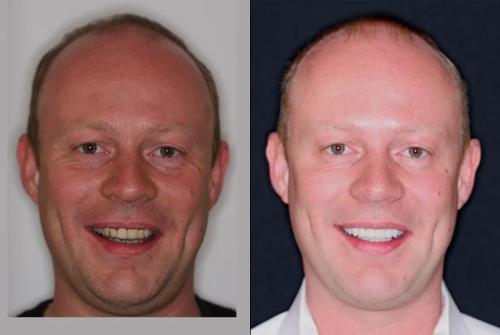 BEFORE-AFTER-veneers-crowns-smile-face-1.jpg_converted