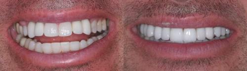 Case-2-BEFORE-AFTER-crowns-veneers-smile-2-scaled.jpg_converted