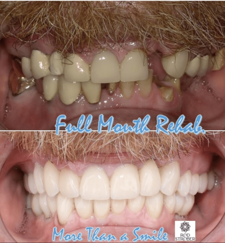 Full-mouth-Upper-and-Lower-implants-Corwns-and-Bridges-e1731602010342
