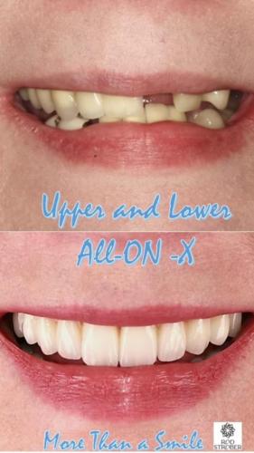Upper-and-Lower-Implants-and-.hybrids