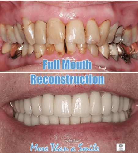 Upper-and-Lower-full-mouth-reconstruction.-Crowns-e1731602067300